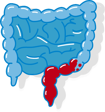 Colitis Ulcerosa Variante Enddarm