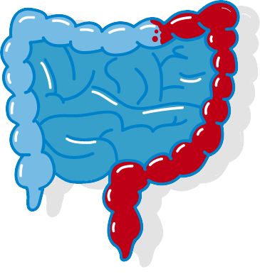 Colitis Ulcerosa Variante Dickdarmhälfte